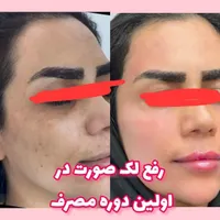 درمان لک ومشکلات پوستی|آرایشی، بهداشتی، درمانی|رشت, کوی جام جم|دیوار