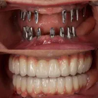 ایمپلنت با پیش‌پرداخت 2میلیون900