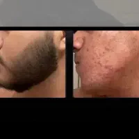 فیس پرپشت و مردونه