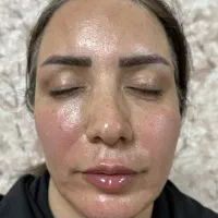 فیلر بوتاکس جوانساز جراحی بادی نخ مزو هیرفیلر