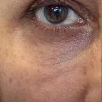 جشنواره ژل و بوتاکس و پی ار پی در مطب توسط پزشک|خدمات آرایشگری و زیبایی|شیراز, چوگیاه|دیوار