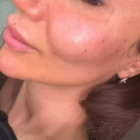 ژل و بوتاکس مزو ابرو مو صورت...