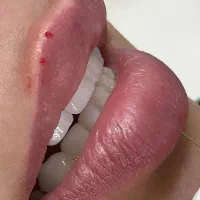 (کلینیک دنا)  فیلر لب ژل‌لب ،زاویه سازی ،طبیعی|خدمات آرایشگری و زیبایی|یاسوج, |دیوار