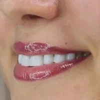 دندونات زرد و سیاه و شکسته روکش زیرکونیوم کن