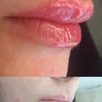 لیزر ژل وبوتاکس وخالبرداری سم زدایی|خدمات آرایشگری و زیبایی|تبریز, |دیوار