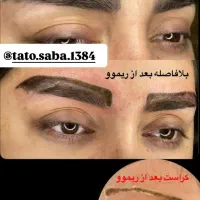 ریموو تک جلسه  با تخفیف ویژه|خدمات آرایشگری و زیبایی|تربت جام, پاسداران|دیوار