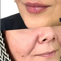 فیلر بوتاکس لیفت با نخ