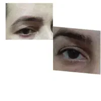 کوچک کردن بینی.رفع افتادگی‌پلک و چروک صورت|خدمات آرایشگری و زیبایی|زاهدان, |دیوار