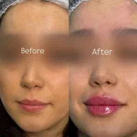 لیزر،بوتاکس، مزوتراپی، فیلر،وایتینگ