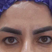 بلفاروپلاستی اقساطی زیبایی چشم