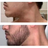 ریش کم‌پشت، ظاهر کم‌جون