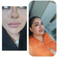 تزریق تخصصی فیلر، بوتاکس، ژل ، مطب زیبایی|خدمات آرایشگری و زیبایی|شیراز, سینما سعدی|دیوار