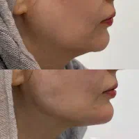هایفو صورت۹۹۹هزارتومان|خدمات آرایشگری و زیبایی|اهواز, اهواز|دیوار