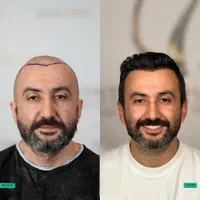 کاشت مو و ابرو و ریش بدون جراحی تراکم بالا|خدمات آرایشگری و زیبایی|تهران, الهیه|دیوار