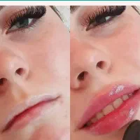 جشنواره ۵۰ درصدی تزریق فیلر و بوتاکس فقط ۱۱۰۰
