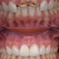 روکش دندان چهار