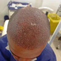 کاشت مو تخصصی دلربا|خدمات آرایشگری و زیبایی|حمیدیه, |دیوار