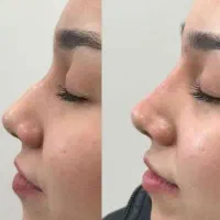 تزریق ژل  بوتاکس  فیلر  پرسینگ|خدمات آرایشگری و زیبایی|قم, نیروگاه|دیوار
