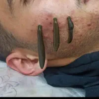 زالودرمانی .حجامت .طب سوزنی