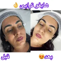 پلاژن تراپی /هایفو تراپی /لیزر بدن/کربوکسی|آرایشگاه و سالن‌های زیبایی|مشهد, کارگران|دیوار