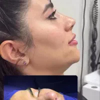 جشنواره جراحی و عمل بینی در کرج و تهران|خدمات آرایشگری و زیبایی|کرج, عظیمیه|دیوار