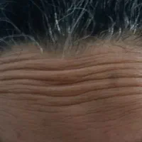 بوتاکس