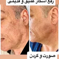 ار اف فرکشنال و روشن کننده کرربن معجزه پوست