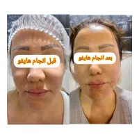 تخفیف استثنایی هایفوصورت،واژینال،کک،مک،درمان تیرگی|خدمات آرایشگری و زیبایی|تهران, هاشمی|دیوار