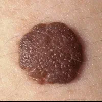 زگیل تناسلی با لیزر زیگیل اچ پی وی HPV درمان زائده