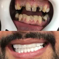 عصب کشی دندان روکش کامپوزیت دندانپزشکی متخصص شهرک|خدمات زیبایی و سلامت|تهران, تهرانسر مرکزی|دیوار