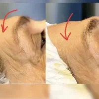 فشیال تخصصی و پاکسازی با دستگاه (قیمت فوق العاده )