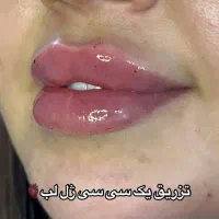 آموزش  و ارائه  ژل و بوتاکس و مزو|خدمات آموزشی|شیراز, سینما سعدی|دیوار