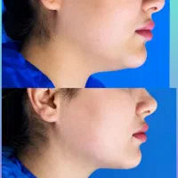 افرویژه بلفاروپلاستی ،رفع غبغب،بوکال فت،سانترال لب