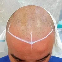 کاشت مو ریش ابرو