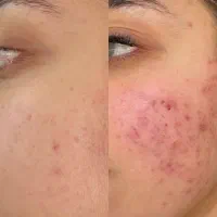 فیشیال تخصصی، درماپلنینگ، کربوکسی تراپی