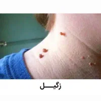 محلول درمان زگیل و زگیل تناسلی|آرایشی، بهداشتی، درمانی|میناب, |دیوار