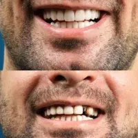 لمینت مترحک دندان اصل|آرایشی، بهداشتی، درمانی|ایلام, |دیوار