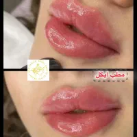 تزریق ژل وفیلر لب و گونه و چانه و..(جشنواره)درمطب