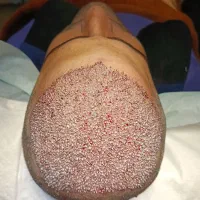 کمک کاشت مو