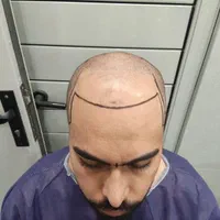 کاشت مو فول تراکم با حداقل ۲۰ هزار تار مو کاشت|خدمات آرایشگری و زیبایی|قزوین, |دیوار