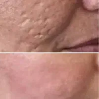 آفر لیزرکربوکسی co2 رفع جای  جوش وجای بخیه