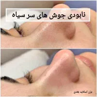 با فیشال تخصصی کلینیک  لک و جوش خود را از بین ببر