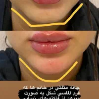 تزریق ژل فیلر بوتاکس مزوتراپی مزوژل لیزر فیشیال|خدمات آرایشگری و زیبایی|کرج, گوهردشت|دیوار