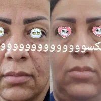 پوست صاف و بدون لک میخوای