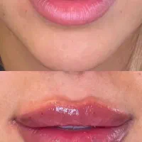 تزریق بوتاکس و فیلر قیمت مناسب بوشهر