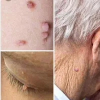 مرکز تخصصی خال و زگیل ذگیل تناسلی لیزر،کرایو|خدمات آرایشگری و زیبایی|تهران, جمهوری|دیوار