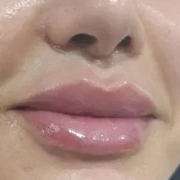 ژل و بوتاکس با تخفیف