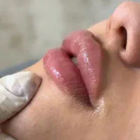 تزریق ژل در صورت