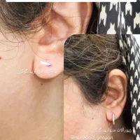 سوراخ کردن گوش با وسایل یکبارمصرف و استریل