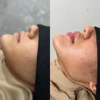 ژل بوتاکس فیلر زاویه ژل لب مطب پزشک|خدمات آرایشگری و زیبایی|قم, ارم|دیوار